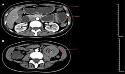 Case report: Submucosal cavernous lymphangioma causing jejuno-jejunal intussusception in an adult